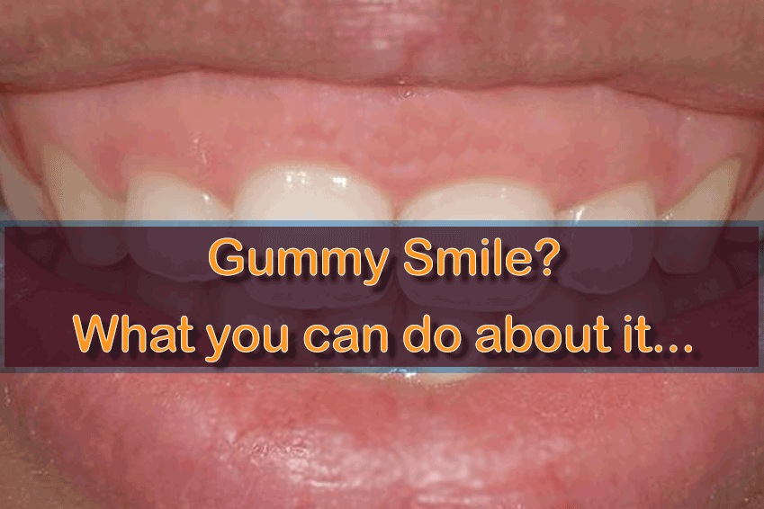 “Gummy Smile”? What You Can Do About It