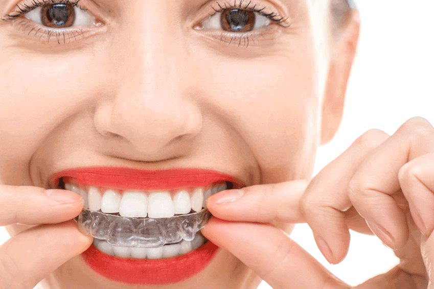 Invisalign Tips